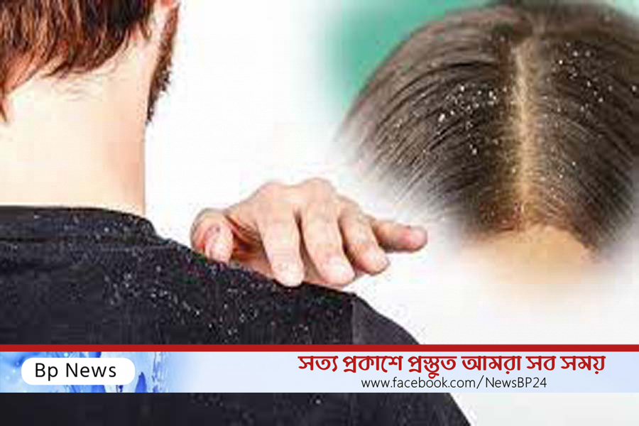 খুশকি দূর করার সহজ উপায়