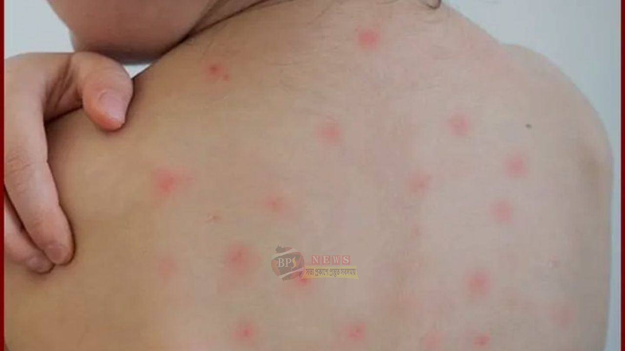 নারায়ণগঞ্জে হাম রোগে দুই শিশুর মৃ'ত্যু, হাসপাতালে আরও ৯