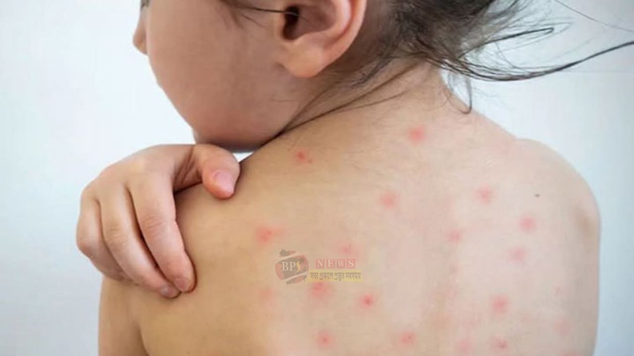 নারায়ণগঞ্জে হাম সন্দেহে ৭৯ শনাক্ত, টিকায় আসছে সাড়ে ৩ লাখ শিশু