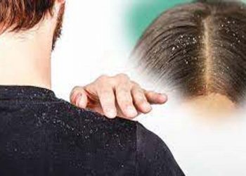 খুশকি দূর করার সহজ উপায়