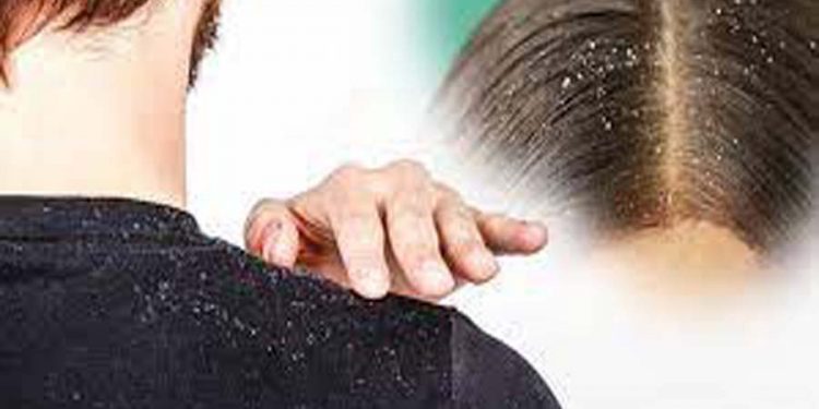 খুশকি দূর করার সহজ উপায়